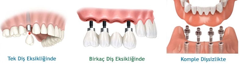 İmplant Tedavi Süreci Acı Verici midir?