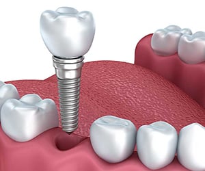 İmplant Tedavisi Nasıl Yapılır?