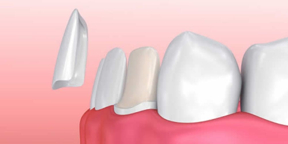 Lamine diş kaplama nedir?