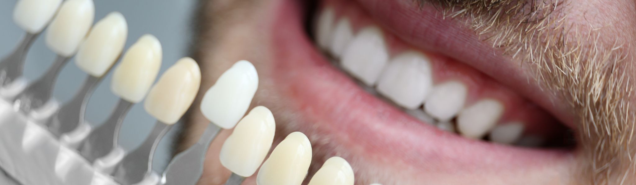 Zirkonyum dişin tercih edilme nedenleri